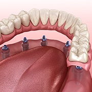 A digital image of a lower arch with 6 dental implants in Oklahoma City and a full denture