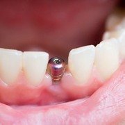 Dental implant