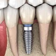 Dental implant in jaw