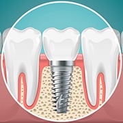 single dental implant post in the jaw