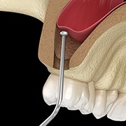 sinus lift