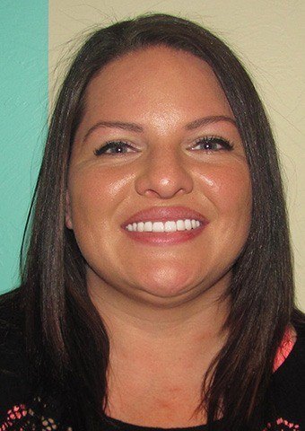 Jessi's smile after treatment