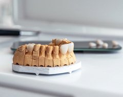 a model of a mouth with Lumineers placed on some of the teeth