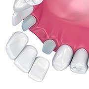 Animation of dental bridge placement