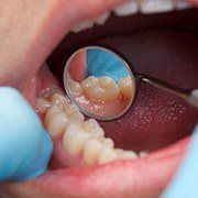 Closeup of tooth after filling