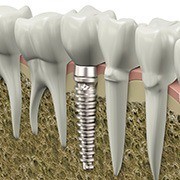 Animation of implant retained dental crown