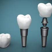 Components of a single dental implant.