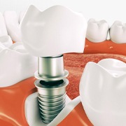 Digital model of a single tooth implant.
