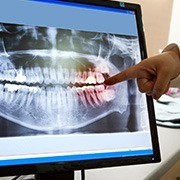 Dental x-rays on computer screen