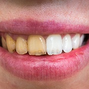 Before and after image of teeth whitening.