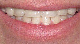 Closeup of Zach's smile after treatment