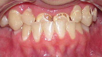 Closeup of Zach's smile before treatment