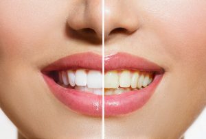 Woman's teeth before and after whitening